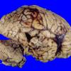 9A2 Thrombosis, SSST & TV sinuses (Case 9) 2 copy