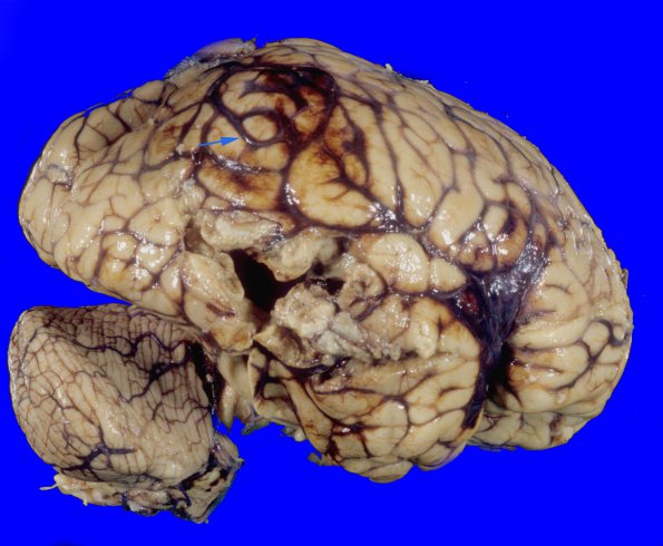 9A2 Thrombosis, SSST & TV sinuses (Case 9) 2 copy