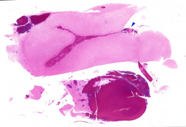 9B1 Thrombosis, SSST & TV sinuses (Case 9) N12 H&E WM copy