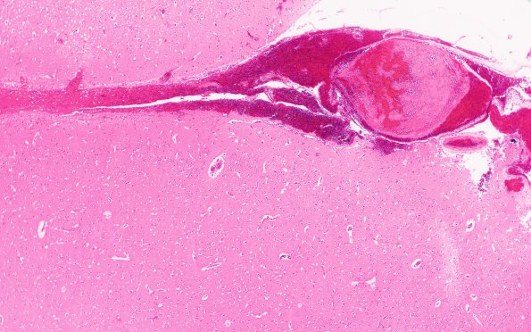 9B2 Thrombosis, SSST & TV sinuses (Case 9) N12 H&E 3