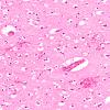 9B3 Thrombosis, SSST & TV sinuses (Case 9) H&E 3