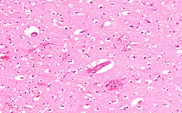 9B3 Thrombosis, SSST & TV sinuses (Case 9) H&E 3