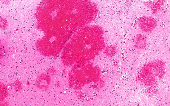 9B4 Thrombosis, SSST & TV sinuses (Case 9) H&E 2