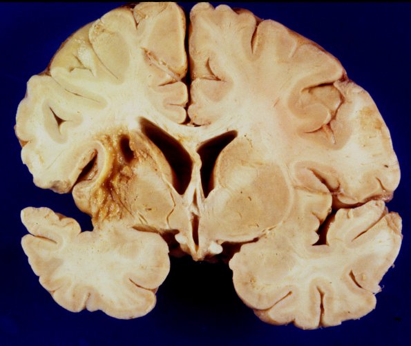 1A1 Infarct, remote (4 years), (Case 1) 11