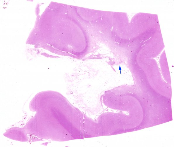 1A3 Infarct, 4 years Old (Case 1) H&E whole mount copy