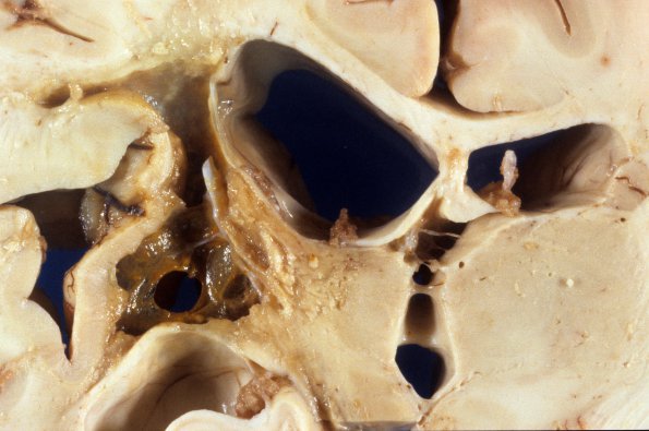 1A7 Infarct, remote (4 years), (Case 1) 1