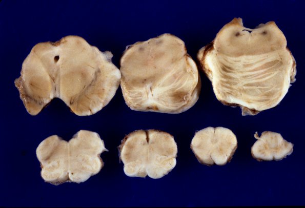 1B Infarct, remote (4 years), (Case 1) 6