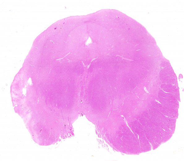 1C2 Infarct, remote (4 years), (Case 1) Midbrain, H&E whole mount