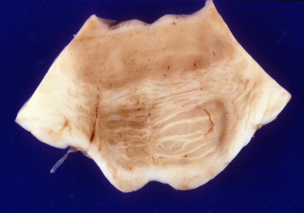 1D2 Infarct, remote (4 years), (Case 1) 4