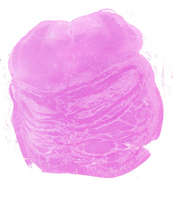 1D4 Infarct, Old (Case 1) tract degeneration Pons, H&E whole mount