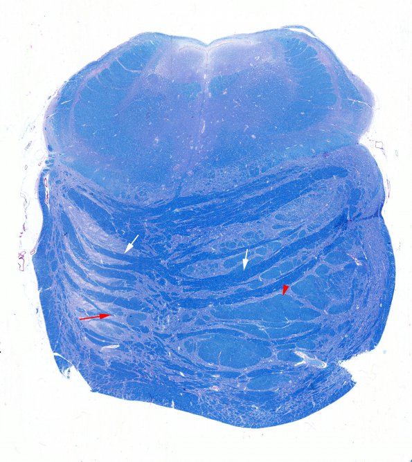 1D5 Infarct, Old (Case 1) tract degeneration LFB-PAS whole mount 2 copy