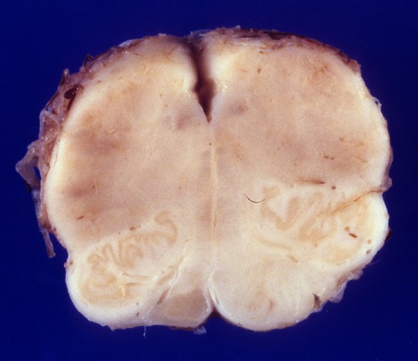 1E2 Infarct, remote (4 years), (Case 1) 3