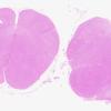 1E3 Infarct, Old (A31336) tract degeneration Medulla, H&E whole mount A