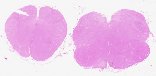 1E3 Infarct, Old (A31336) tract degeneration Medulla, H&E whole mount A