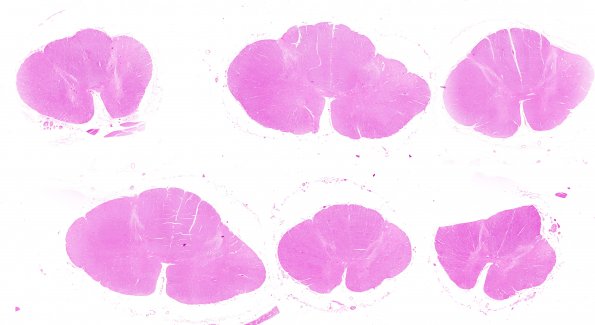 1F2 Infarct, Old (Case 1) tract degeneration Spinal Cord, H&E whole mount Final