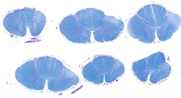 1F3 Infarct, Old (Case 1) tract degeneration Spinal Cord, LFB-PAS whole mount Adobe 1