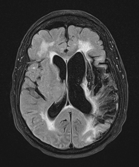 2A1 Tract Degeneration (Case 2) FLAIR - Copy