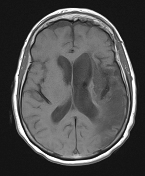 2A2 Tract Degeneration (Case 2) T1Ax noC - Copy