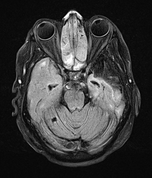 2A5 Tract Degeneration (Case 2) FLAIR 3 - Copy