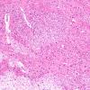 2B12A3 Tract Degen (Case 2) N15 H&E 10X