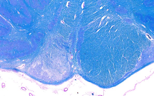 2B14D2 Tract Degen (Case 2) N19 2X