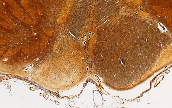 2B14E2 Tract Degen (Case 2) N19 Biels 2X