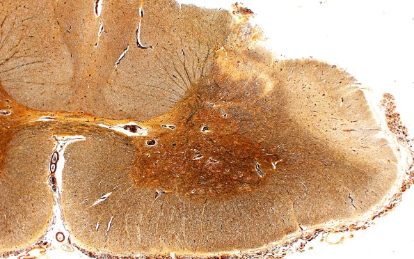 2B16C2 Tract Degen (Case 2) N18 Biels 2X