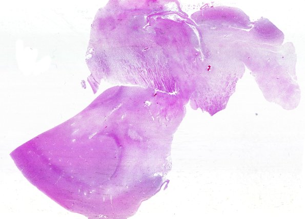 2B3C Tract Degen (Case 2) N12 H&E