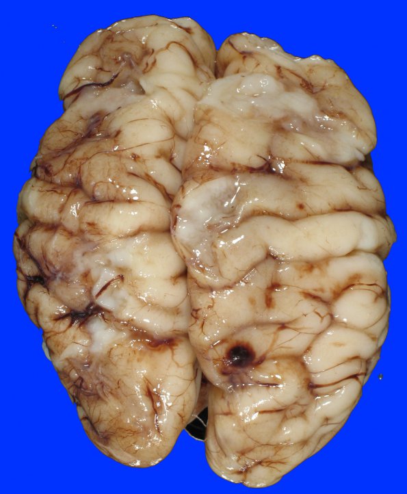 12A1 Infarcts, watershed, neonatal (Case 12) 1