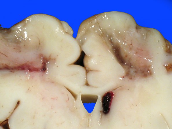 12A4  Infarcts, watershed, neonatal (Case 12) A_4