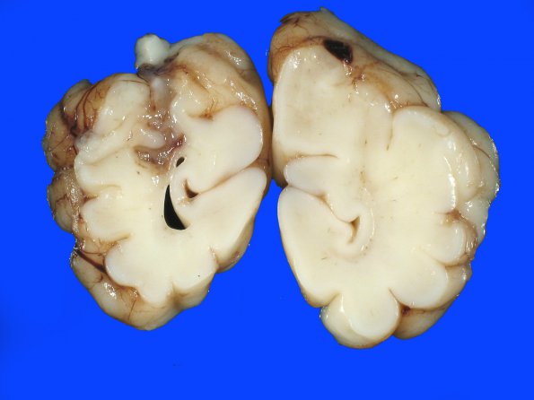 12A7  Infarcts, watershed, neonatal (Case 12) A_8