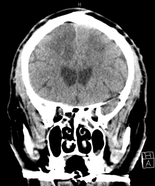 14A1 Infarct, watershed (Case 14) CT 2 - Copy