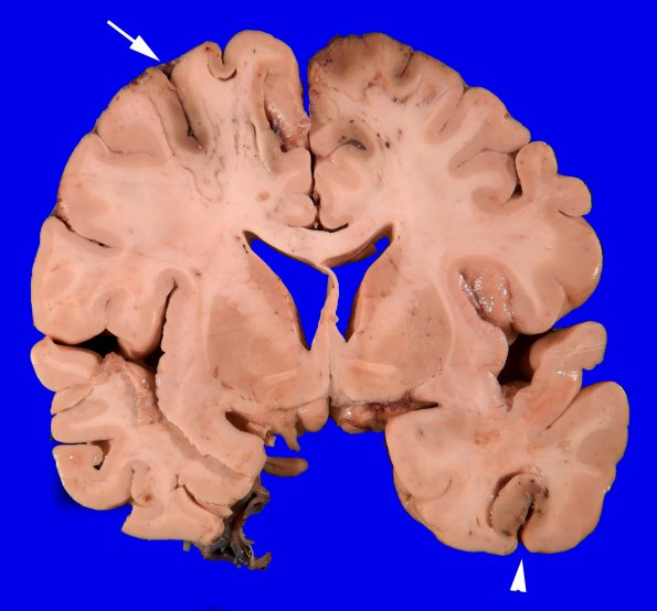 14C3 Infarct, watershed (Case 14)_1 copy