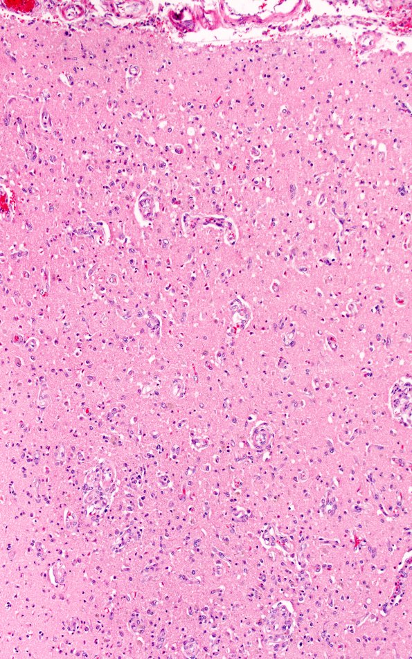14D1 Infarct, watershed (Case 14) N5 H&E WM