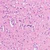 14D2 Infarct, watershed (Case 14) N1 H&E 20X