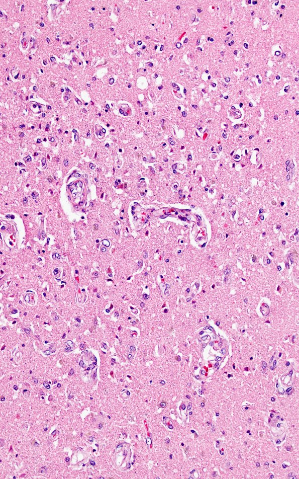 14D2 Infarct, watershed (Case 14) N1 H&E 20X