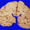 15A1 Infarct (Case 15 ) Gross 1 copy