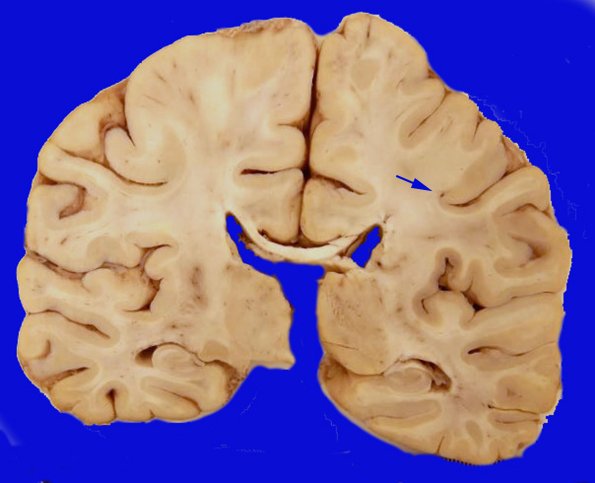 15A1 Infarct (Case 15 ) Gross 1 copy