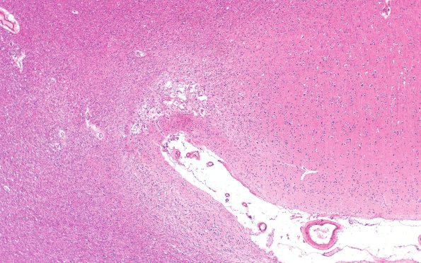 15B3 Infarct (Case 15) H&E A13 4x