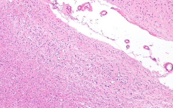 15B4 Infarct (Case 15) H&E A13 10X 1