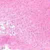 15B5 Infarct (Case 15) H&E A13 10X 2