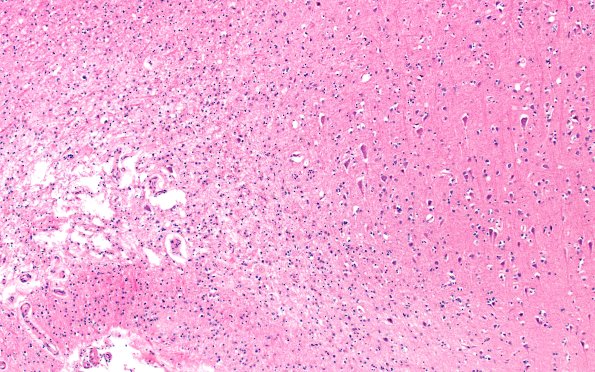 15B5 Infarct (Case 15) H&E A13 10X 2