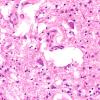 15B6 Infarct (Case 15) H&E A13 40x