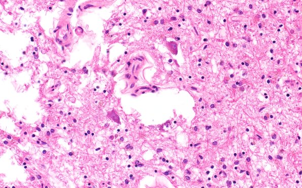 15B6 Infarct (Case 15) H&E A13 40x