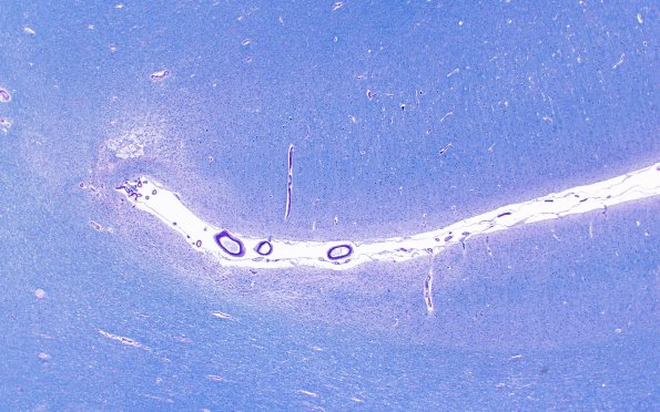 15F2 Mini-watershed (Case 15) A13 LFB-PAS 2X