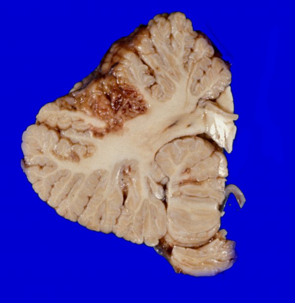 1A8 Infarct, watershed (Case 1) 11