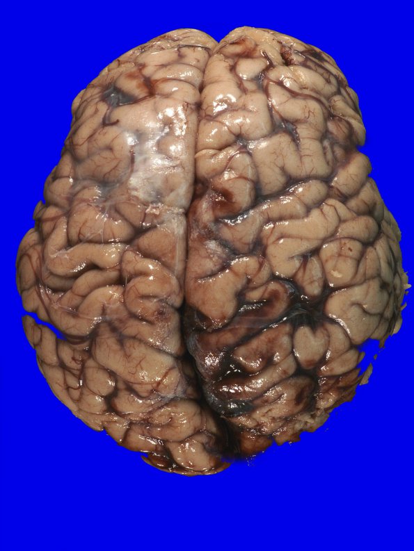 2A1 Infarcts, watershed, Seizures (Case 2)_1