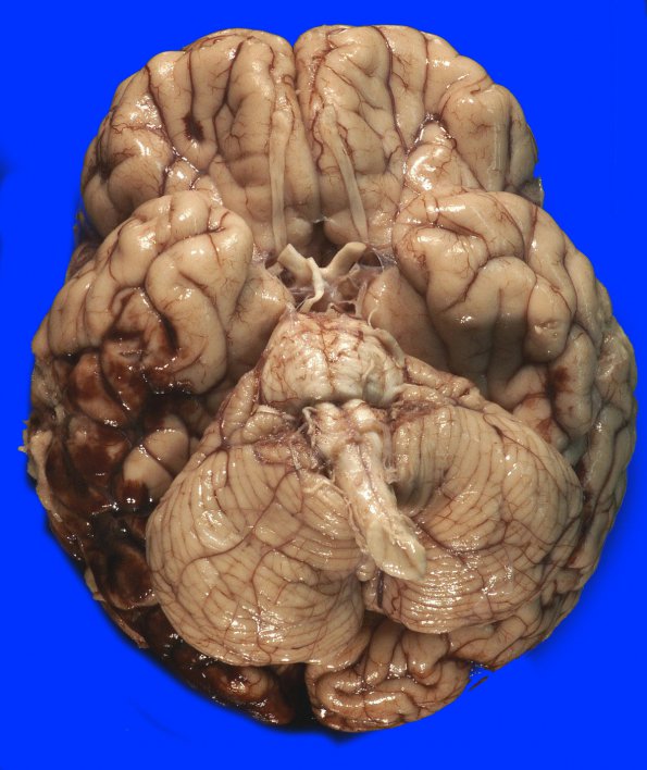 2A2 Infarcts, watershed, Seizures (Case 2)_2