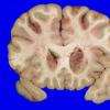 2A3 Infarcts, watershed, Seizures (Case 2)_5