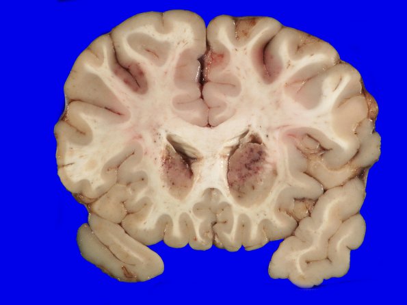 2A3 Infarcts, watershed, Seizures (Case 2)_5